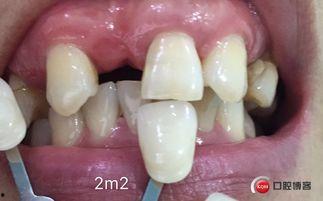 成人牙缝修复方法视频,成人牙缝修复方法视频深度解析